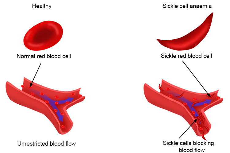 Diagram showing how sickle cell disease is problematic compared to normally shaped red blood cells